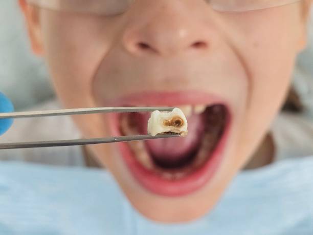 Best Urgent Care for Lost Fillings or Crowns in Butler, AL